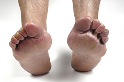 Foot Pain and Rheumatoid Arthritis