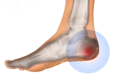 Heel Pain Causes and Risk Factors