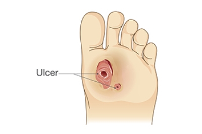 Understanding Diabetic Foot Wounds